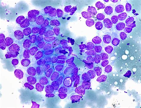 Papillary Thyroid Carcinoma Fna Giemsa Stain Note Intran Flickr