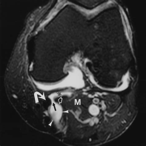 Sonographic Detection Of Baker S Cysts Comparison With Mr Imaging Ajr