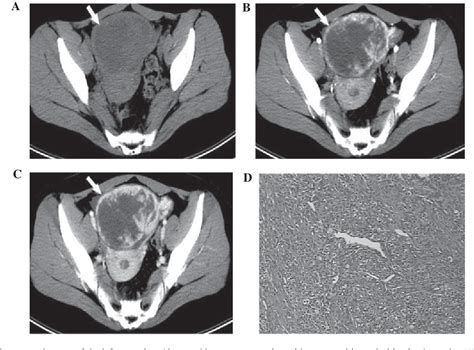 Figure 1 From Ct Findings Of Sclerosing Stromal Tumor Of The Ovary A