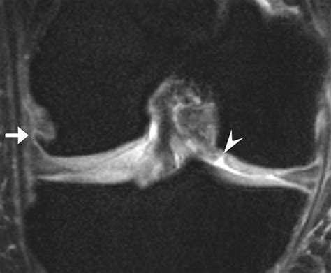 Detection Of Osteophytes And Subchondral Cysts In The Knee With Use Of Tomosynthesis Radiology