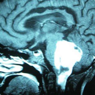 Mr Imaging Brain T Weighted Sagittal Post Contrast Image Intensely