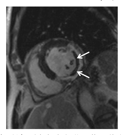 Table From The Emerging Role Of Cardiovascular Mri For Suspected