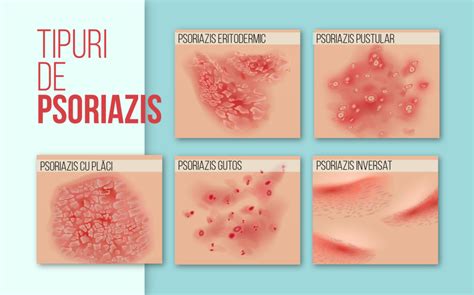 Psoriazis In Placi Stenemetsym S Ownd