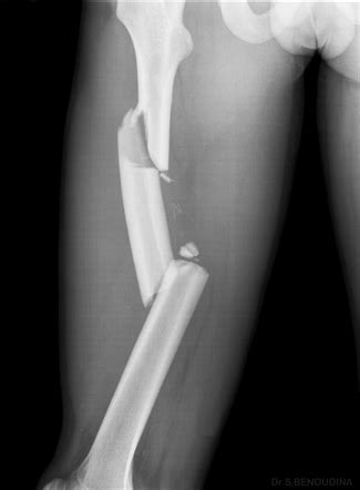 Segmental fracture | Radiology Reference Article | Radiopaedia.org