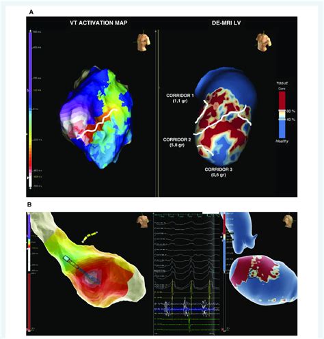 Comparison Between The Eam From The Vt Procedure And Lge Cmr Panel A