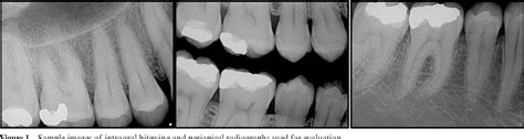 Figure From A Comparison Of Diagnosis Of Early Stage Interproximal