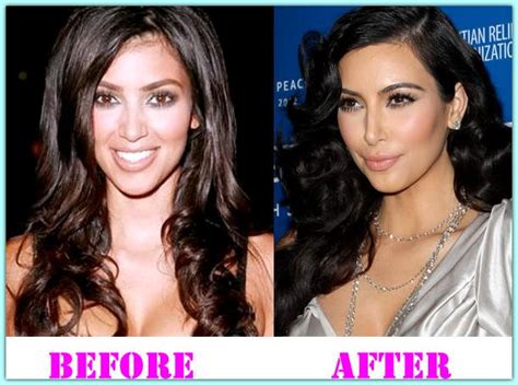 Pin On Celebrities Plastic Surgery Before And After