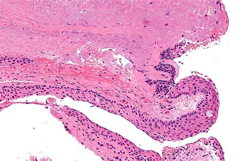 Pterygium - Libre Pathology