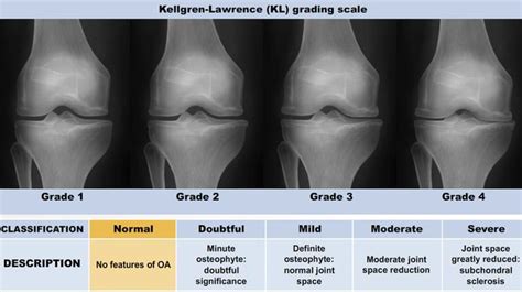 Pin on Ortho Knee