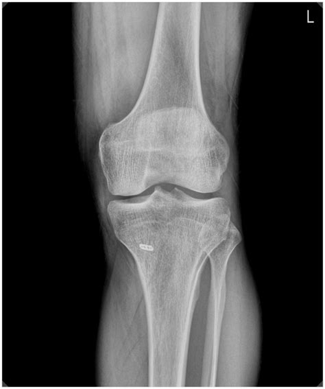 성내동 정형외과 Patella Fx 어떻게 치료할까요 네이버 블로그