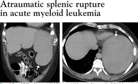 Figure 1 From Atraumatic Splenic Rupture In Acute Myeloid Leukemia