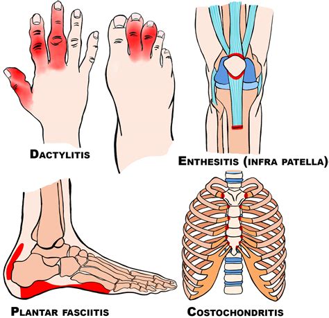 Masterclass Axial Spondyloarthritis For Osteopaths And Manual Therapists International