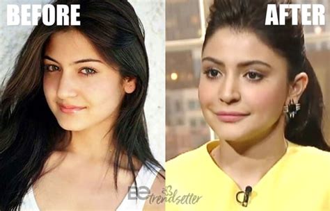 Anushka Sharma Plastic Surgery Disaster Controversy Exposed