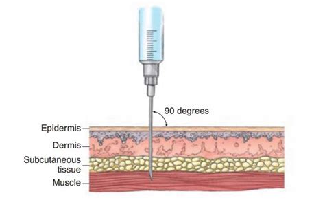 Three Intramuscular Injection Sites