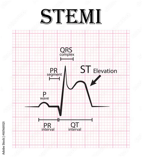 Stockvektorbilden Ecg Of St Elevation Myocardial Infarction Stemi