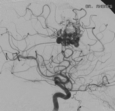 Malformación Arteriovenosa Cerebral