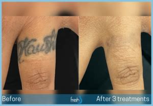 Tattoo Removal Nw Calgary Fresh Laser Skin Studio