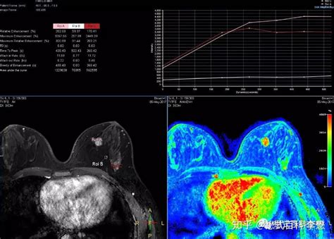 磁共振乳腺扫描规范及全流程技术分享 知乎