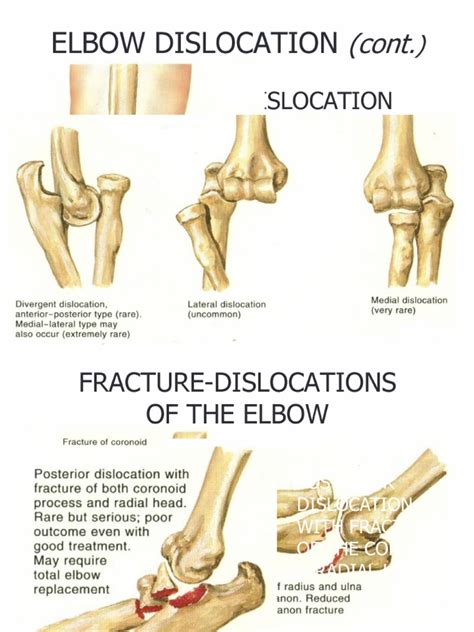 05 Fractures of The Upper Extremity Part 2 - Dr. Tan | Descargar gratis ...