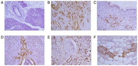 Overexpression of α3 β3 and γ2 chains of laminin332 is associated