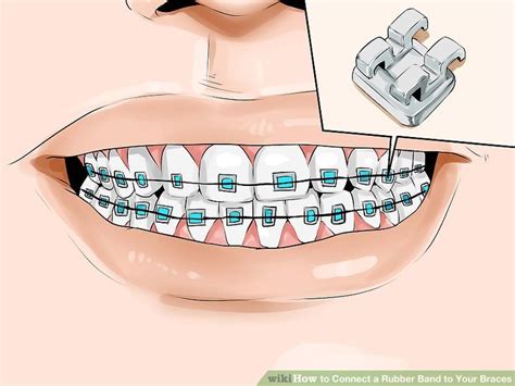 How to Connect a Rubber Band to Your Braces: 12 Steps