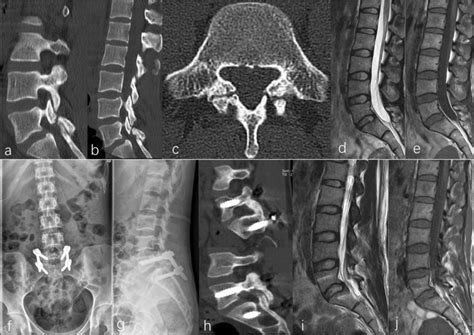 A 23 Year Old Woman Was Admitted To Our Institution Due To Chronic Low Download Scientific