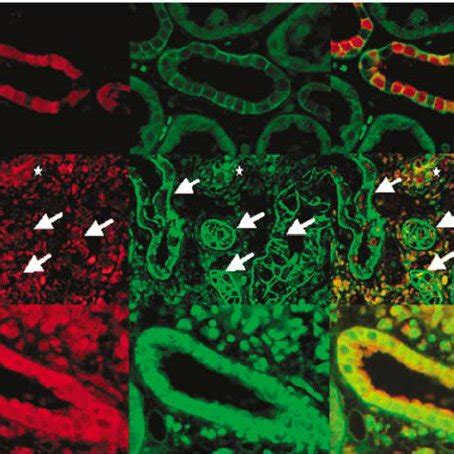 Increased ADAM10 Expression In Allograft Biopsies Of Kidney