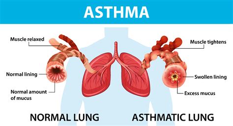 Asthma Diagram With Normal Lung And Asthmatic Lung 3244384 Vector Art