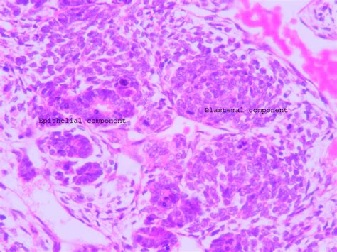 Wilm’s tumor – UG slide – Histopathology.guru