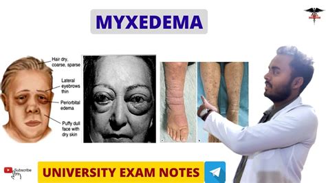 Myxedema Hypothyroidism Endocrine Physiology YouTube