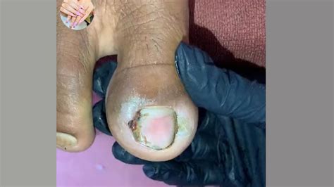 Carefully Cut And Remove Deep Ingrown Toenail YouTube