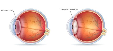 Cataracts Salem Cataracts North Shore Eye Center North Shore