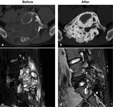 Aneurysmal Bone Cyst Spine Mri