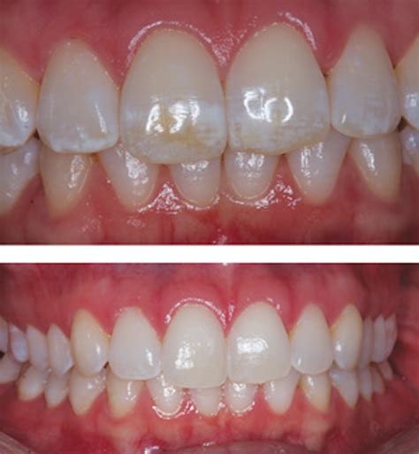 Using Combination Microabrasion Mi Paste And Whitening To Treat Fluorosis Stains Dental