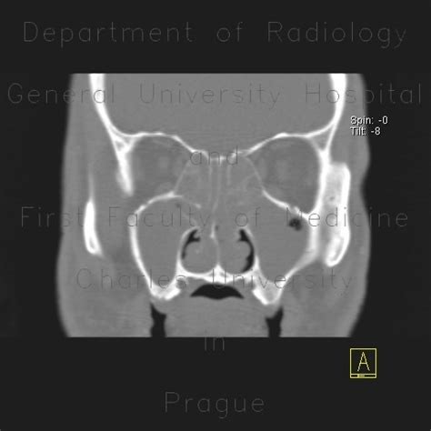 Radiology Case Polyposis Of Nose And Paranasal Sinuses