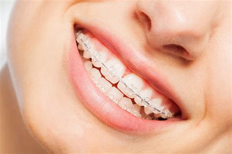 Advantages And Disadvantages Of Ceramic Braces For Teeth