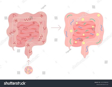 Fecal Microbiota Transplant Healthy Unhealthy Intestine Stock Vector