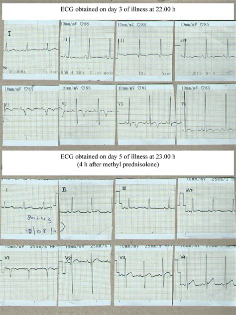 Myocarditis Ecg Changes