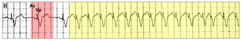 Pacemaker Mediated Tachycardia Resources