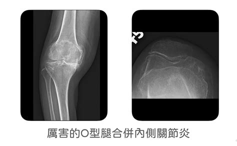 半膝關節置換手術：半膝？全膝？膝關節磨損不用全換更微創？｜蔡尚聞醫師