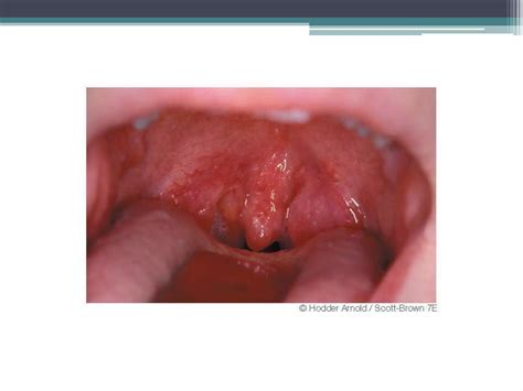 Diseases Of Tonsils And Adenoids Ppt