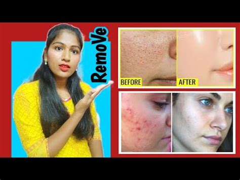 How To Get Rid Of Large Open Pores Permanently Step S Reduce Skin