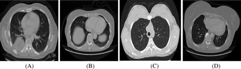 Sample Chest Computed Tomography Scan Images Found In Data Set Download Scientific Diagram