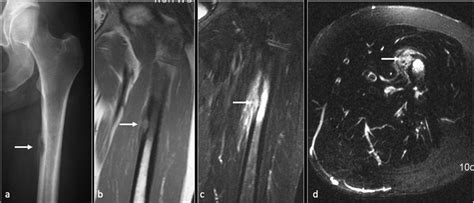 Osteomyelitis With Cortical Abscess Femur Anteroposterior A Download Scientific Diagram