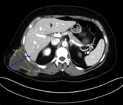 Ct Scan Of Abdomen Pelvis With Iv Contrast Showing Fluid Collection Download Scientific Diagram