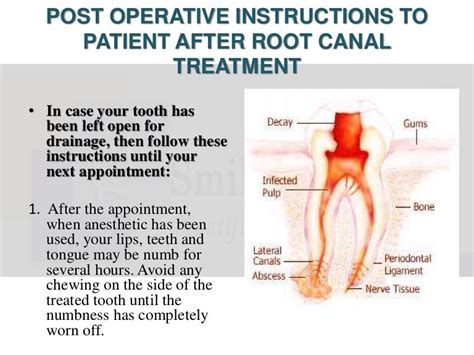 Postoperative Instructions After Root Canal Treatment