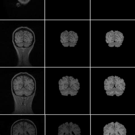 Pdf An Automated And Simple Method For Brain Mr Image Extraction