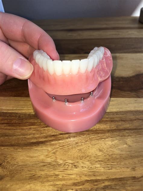 Implant Dentures Mitchell FAQ The Dental Health Partners