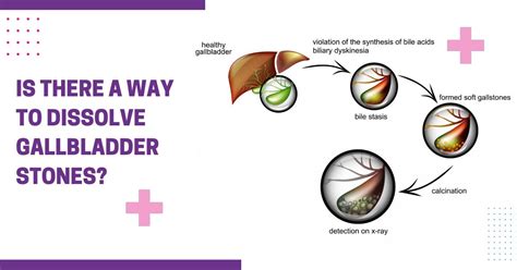 Is There A Way To Dissolve Gallbladder Stones Sri Ramakrishna Hospital