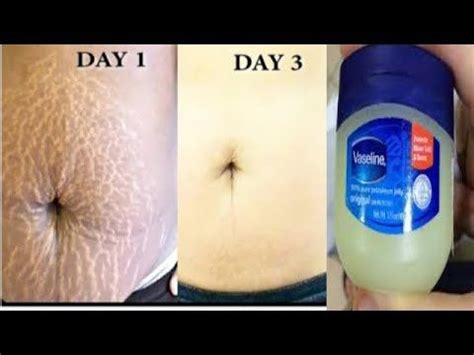 Remove Stretch Mark At Home In Few Days Using Vaseline Youtube